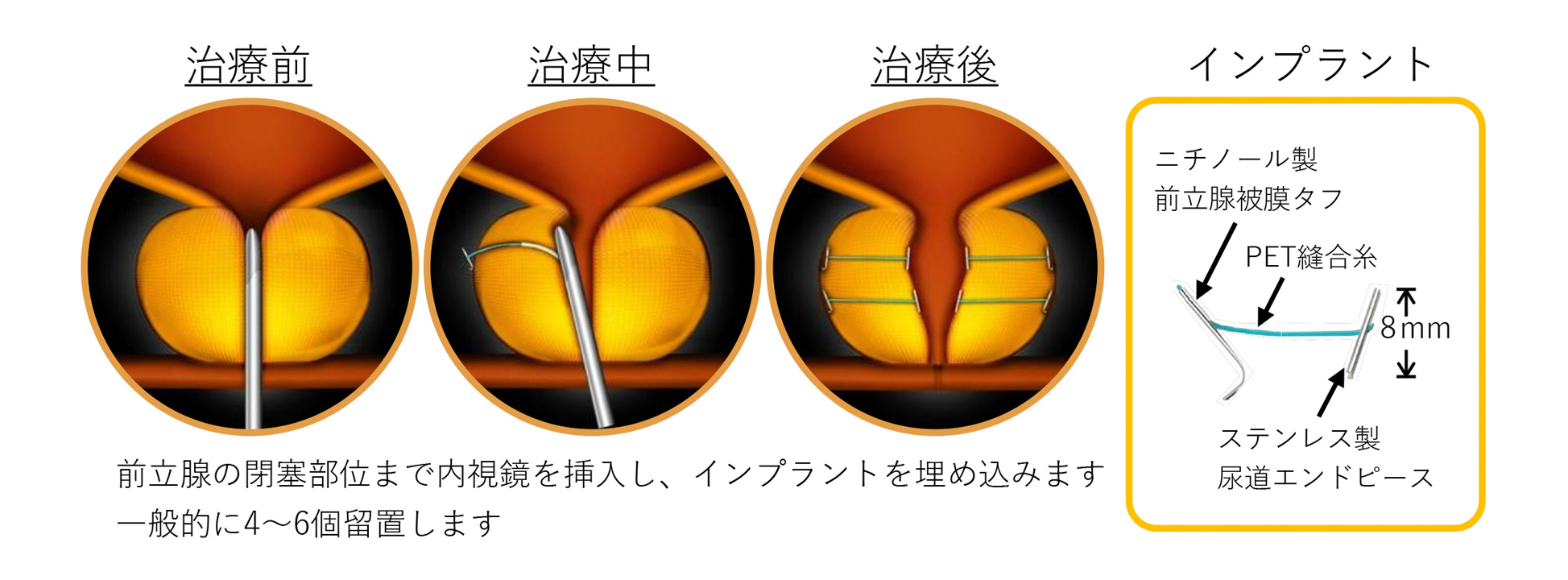 前立腺切除術後の放射線にはリスクがありますか?