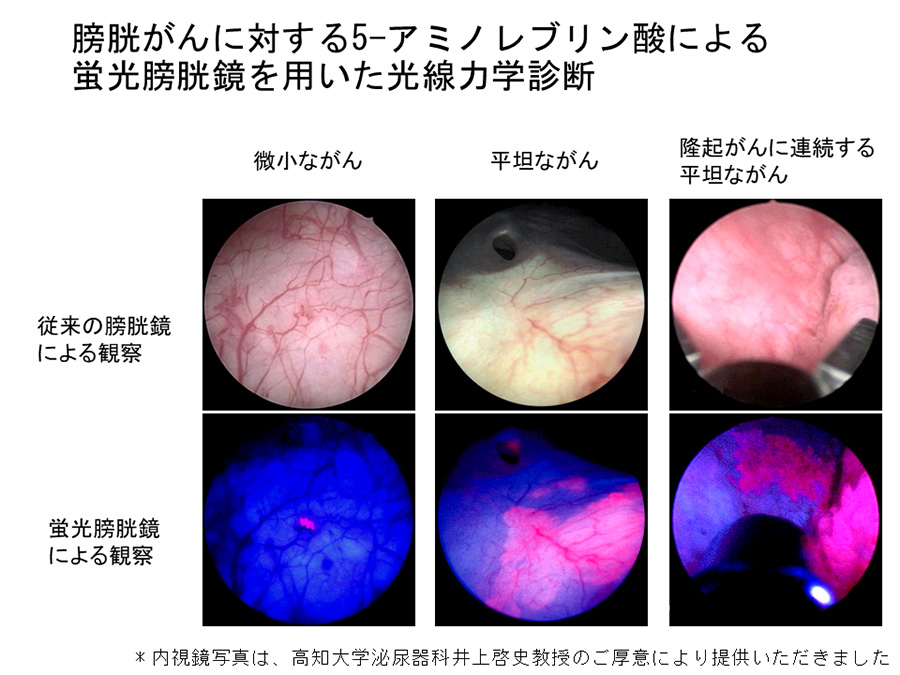 膀胱がんに対する5-アミノレブリン酸による蛍光膀胱鏡を用いた光線力学診断